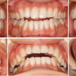 顎関節症、歯ぎしりを伴う開咬の症例
