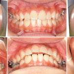 下顎前歯の癒合歯を伴う叢生症例