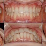 歯肉退縮を伴う上顎前突（出っ歯）の症例