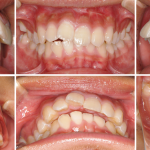 顎関節症を伴う上顎前突の症例