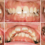 上顎前突(出っ歯)及びすきっ歯・口唇閉鎖不全の症例