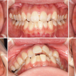 顎変形症を伴う出っ歯及び叢生の症例