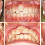 顎関節症、前歯先欠を伴う上顎前突の症例