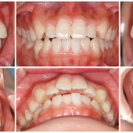 口元突出、前歯前突、デコボコの症例